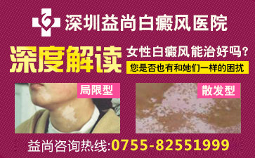 深圳好的白癜风医院讲解女性白癜风患者如何护理