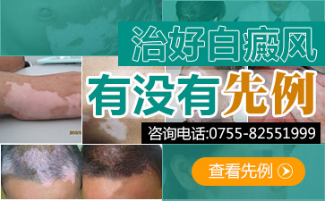 深圳男性白癜风治疗的方法